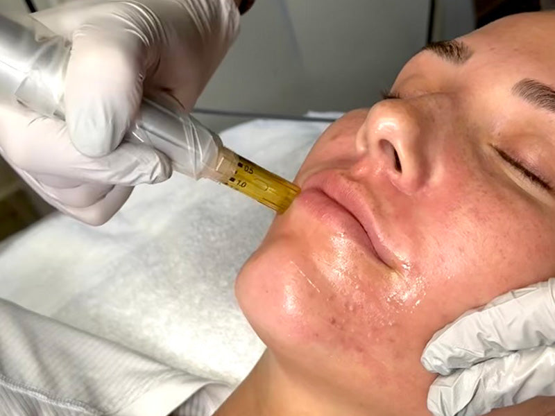 Clear, Calm, Confident Skin: Combining Microneedling & Chemical Peels for Acne Recovery